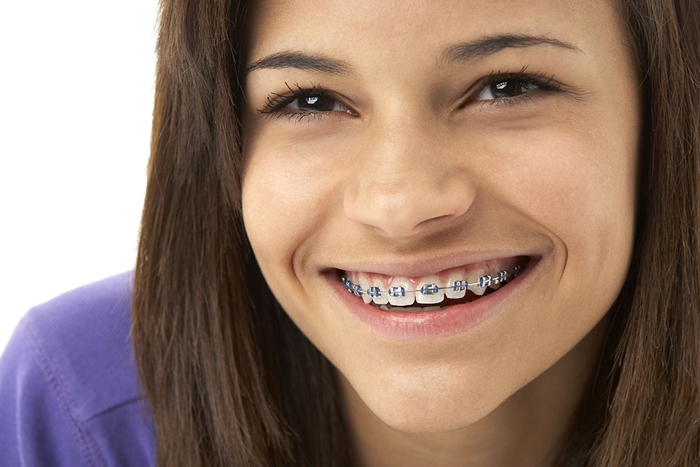 Braces Straighter Teeth For A Wider Smile Dr Smile