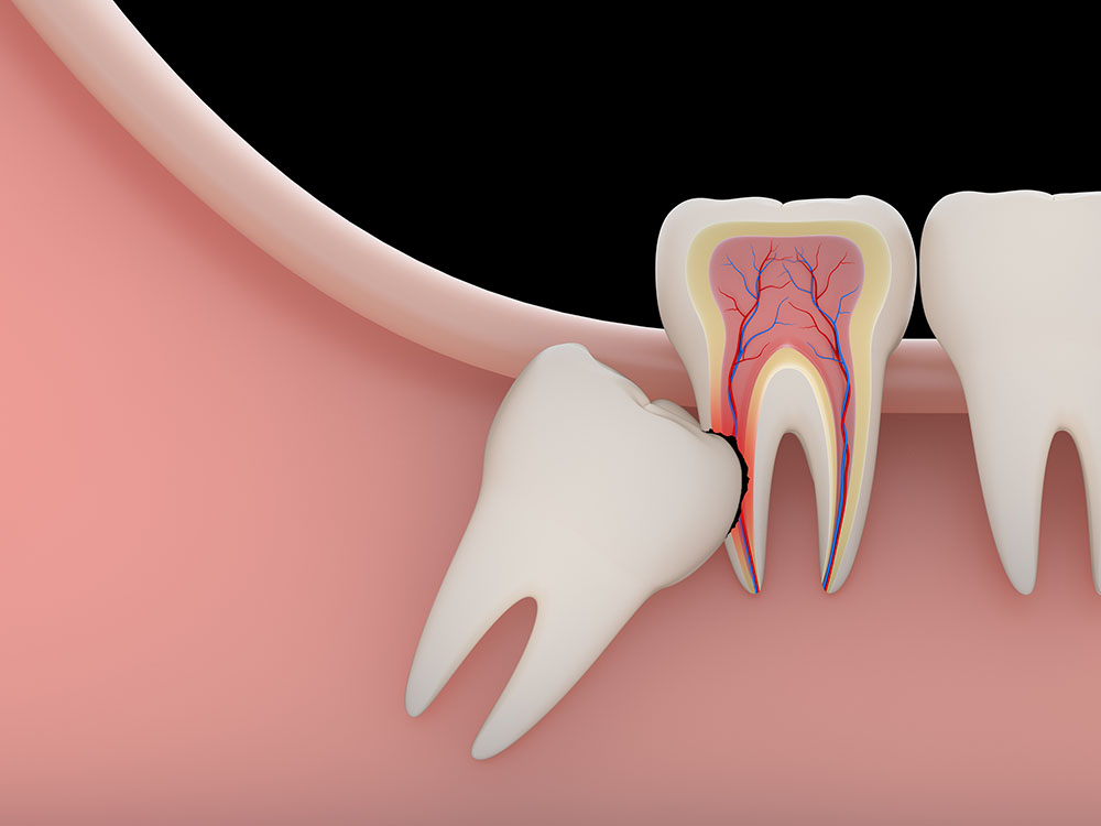 Learn What Will Happen if Wisdom Teeth are Not Removed